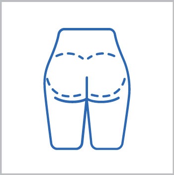 Gluteoplastia
