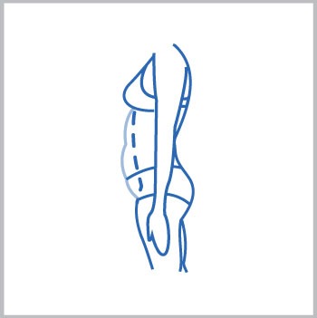 Lipectomia o abdominoplastia