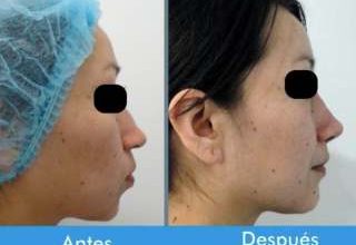 Resultado Rinoplastia