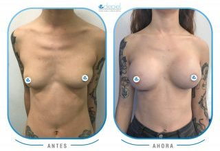 impactante mamoplastia de aumento