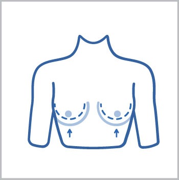 Levantamiento de Senos con Aumento Super Descuento $9.880.000 (Pexia en T invertida)