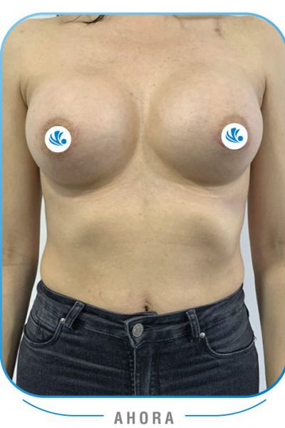 Resultados Mamoplastia de aumento colombia Resultados Mamoplastia de aumento colombia