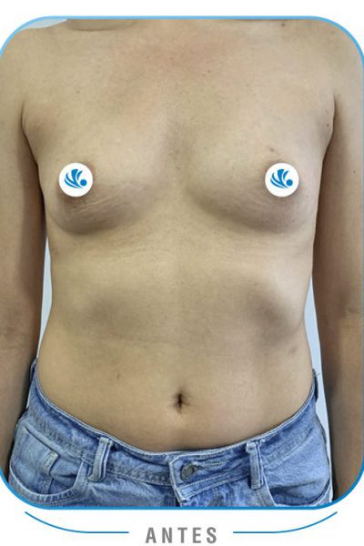 Resultados Mamoplastia de aumento colombia Resultados Mamoplastia de aumento colombia