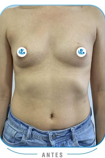 Resultados Mamoplastia de aumento colombia Resultados Mamoplastia de aumento colombia