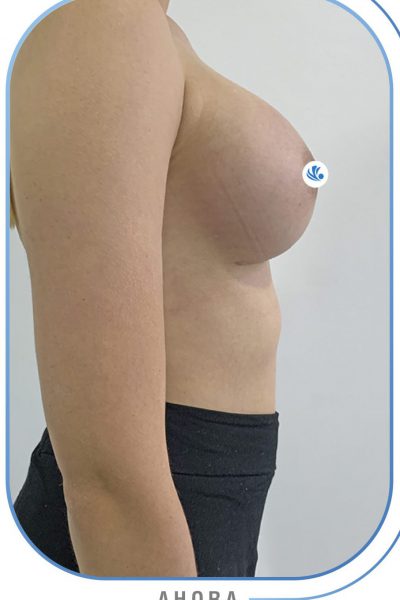 resultados mamoplastia de aumento resultados mamoplastia de aumento