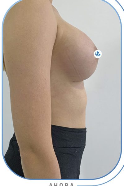 resultados mamoplastia de aumento resultados mamoplastia de aumento