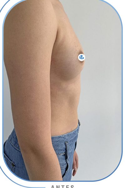 resultados mamoplastia de aumento resultados mamoplastia de aumento